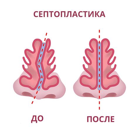 ilustrácia typov operácií nosa (rinoplastika, septoplastika, FESS)