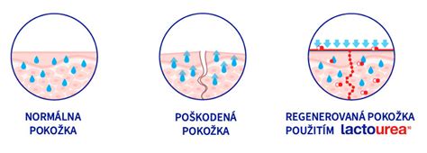 Ilustrácia vplyvu suchej pokožky a dýchacích ciest