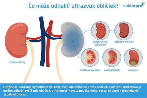 Infografika zobrazujúca rozdiely medzi zápalom mechúra a zápalom obličiek