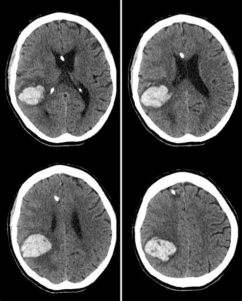 Schéma znázorňujúca rôzne typy vnútrolebečného krvácania (epidurálne, subdurálne, intracerebrálne)